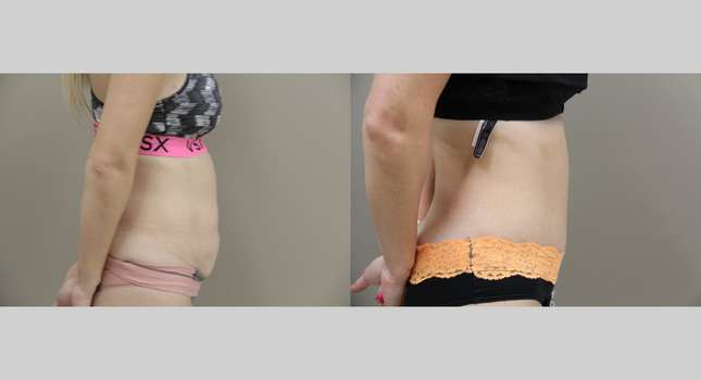 Tummy Tuck: Image #926