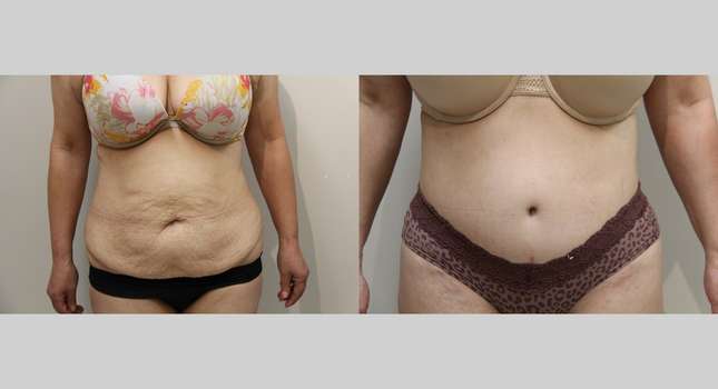 Body Lift: Image #927