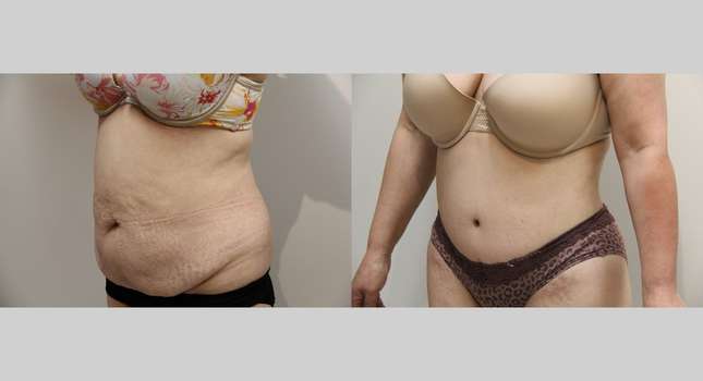 Body Lift: Image #928
