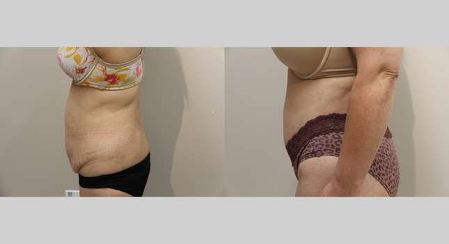 Body Lift: Image #929