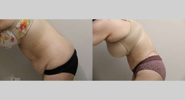 Body Lift: Image #930