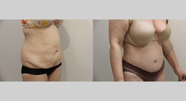 Body Lift: Image #931