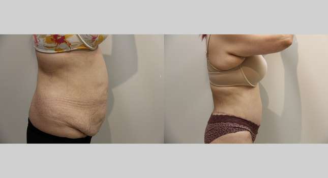 Body Lift: Image #932