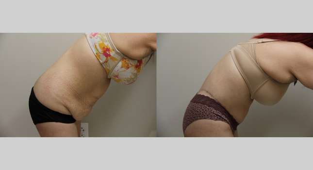 Body Lift: Image #933