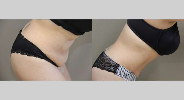 Tummy Tuck: Image #939