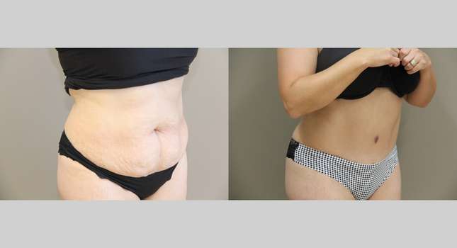Tummy Tuck: Image #940