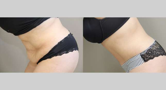 Tummy Tuck: Image #941
