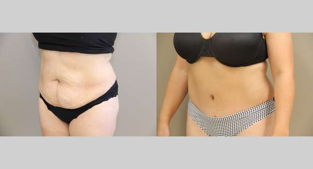 Tummy Tuck: Image #942