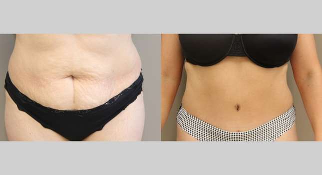 Tummy Tuck: Image #943