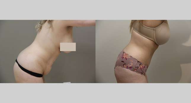 Tummy Tuck: Image #944