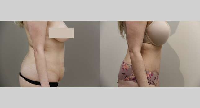 Tummy Tuck: Image #945