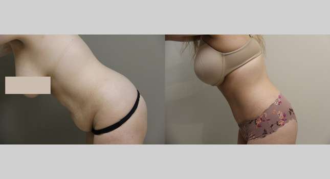Tummy Tuck: Image #946