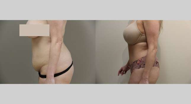 Tummy Tuck: Image #947