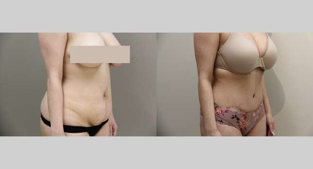 Tummy Tuck: Image #948