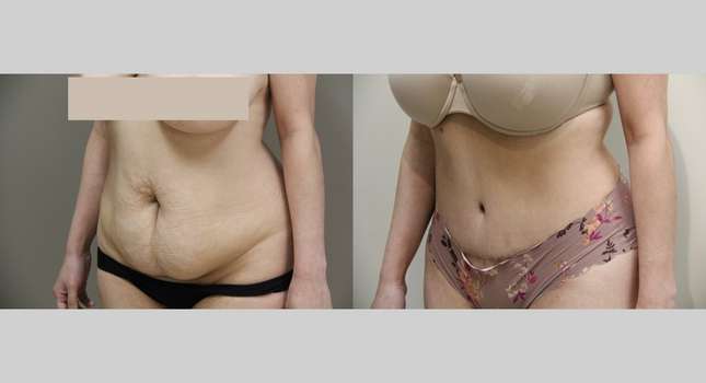 Tummy Tuck: Image #949