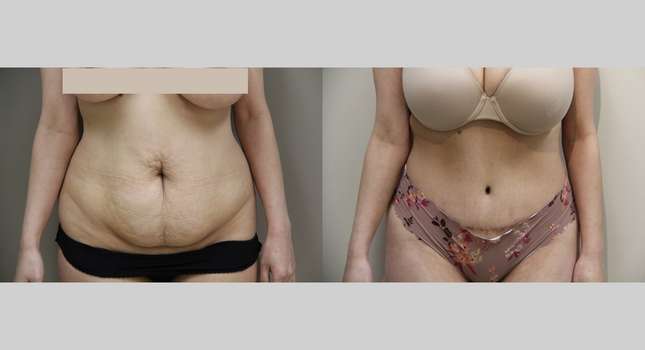 Tummy Tuck: Image #950