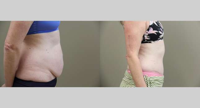 Tummy Tuck: Image #961
