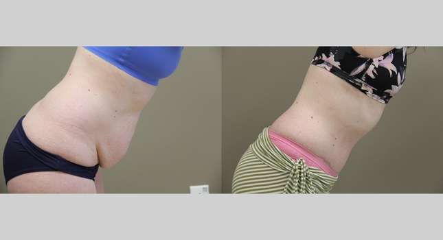 Tummy Tuck: Image #962
