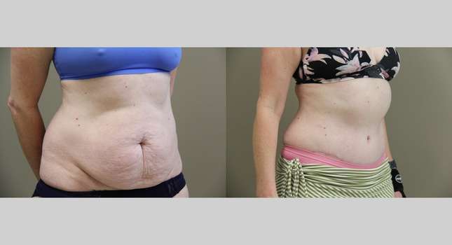 Tummy Tuck: Image #963