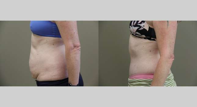 Tummy Tuck: Image #964