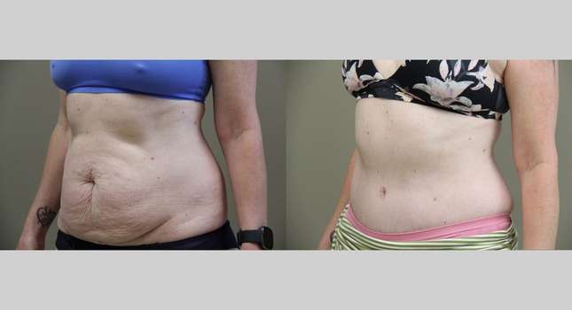 Tummy Tuck: Image #965