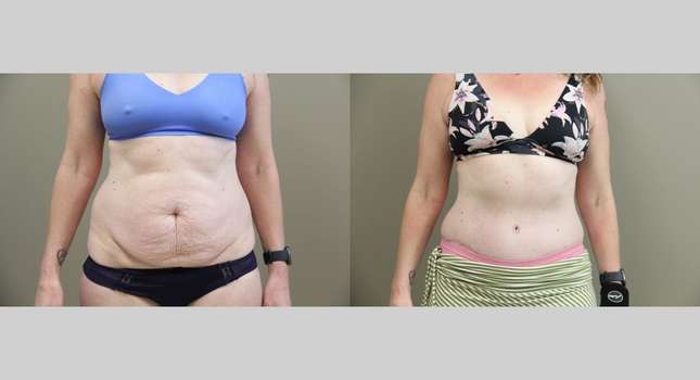 Tummy Tuck: Image #966