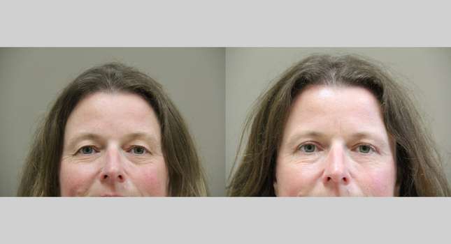 Eyelid Surgery: Image #967
