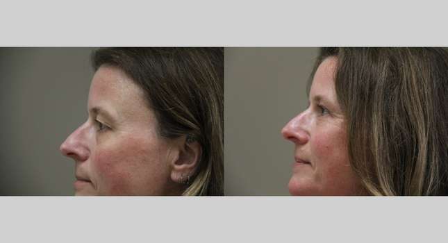 Eyelid Surgery: Image #968