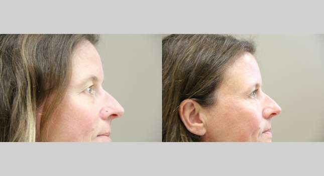 Eyelid Surgery: Image #969