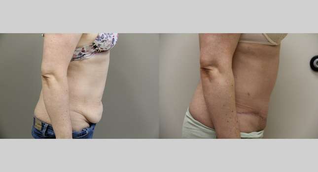 Tummy Tuck: Image #970