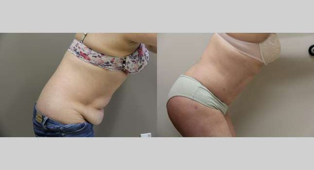Tummy Tuck: Image #971