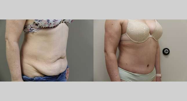 Tummy Tuck: Image #972