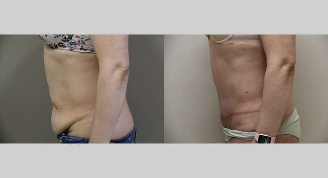 Tummy Tuck: Image #973