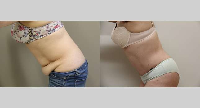 Tummy Tuck: Image #974