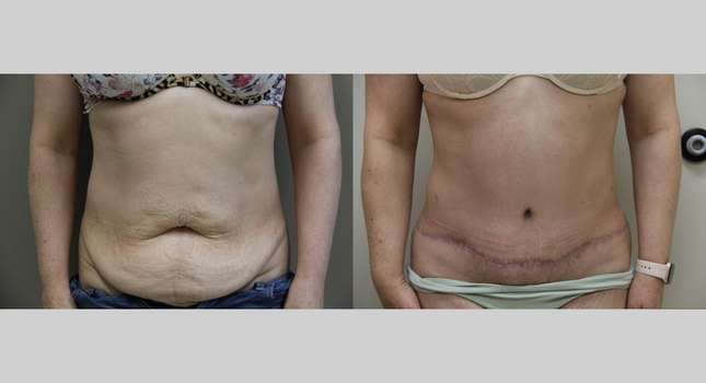 Tummy Tuck: Image #975