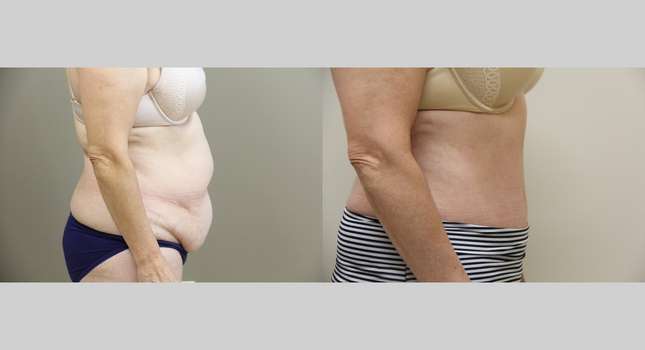 Tummy Tuck: Image #976