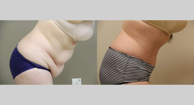 Tummy Tuck: Image #977