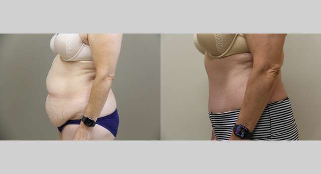 Tummy Tuck: Image #978