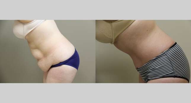Tummy Tuck: Image #979