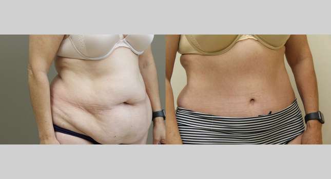 Tummy Tuck: Image #980