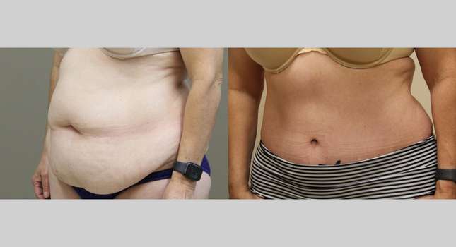 Tummy Tuck: Image #981