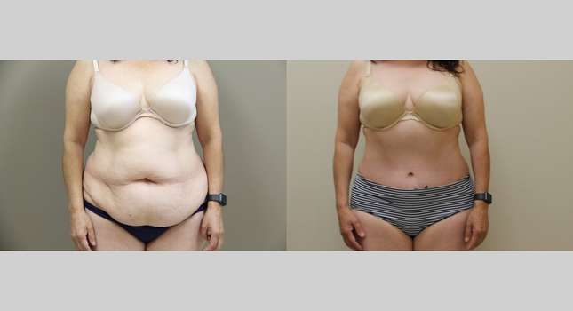 Tummy Tuck: Image #982