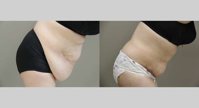 Tummy Tuck: Image #983
