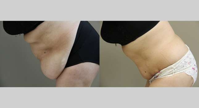 Tummy Tuck: Image #984