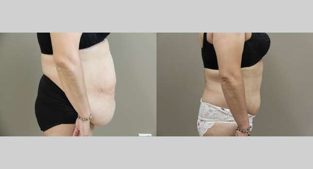 Tummy Tuck: Image #985