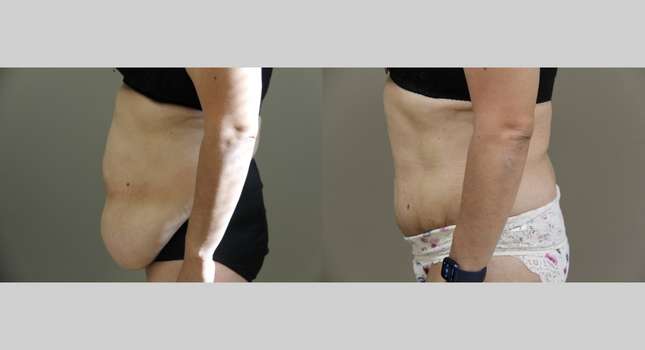 Tummy Tuck: Image #986