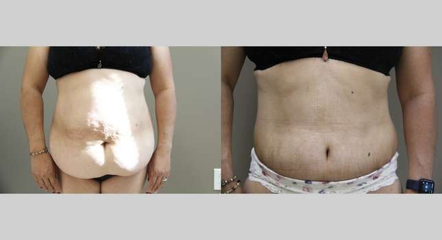 Tummy Tuck: Image #987