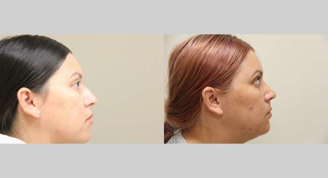 Nose Surgery: Image #988