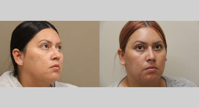 Nose Surgery: Image #989
