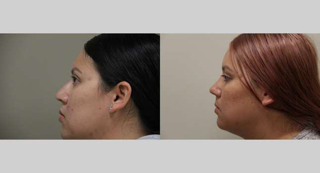 Nose Surgery: Image #990